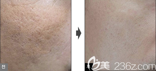 韓國lucea激光美膚案例 韓國lucea激光美膚案例