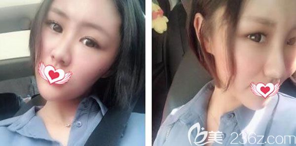 自體脂肪全臉填充術(shù)后第7天摸著很平整 自體脂肪全臉填充術(shù)后第7天摸著很平整