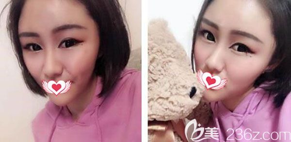 自體脂肪填充一個(gè)月已經(jīng)定型沒有出現(xiàn)大小臉 自體脂肪填充一個(gè)月已經(jīng)定型沒有出現(xiàn)大小臉