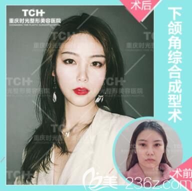 重慶時光下頜角整形案例 重慶時光下頜角整形案例