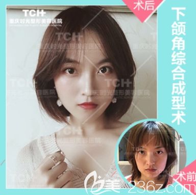 重慶時光下頜角整形 重慶時光下頜角整形