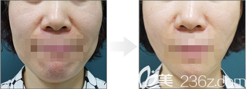 韓國lucea整形醫(yī)院面部提升手術(shù)案例 韓國lucea整形醫(yī)院面部提升手術(shù)案例