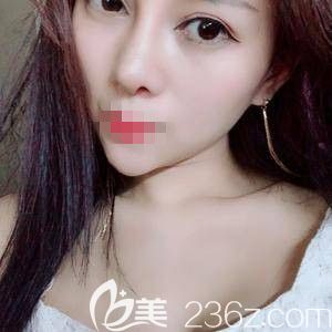 鄭州醫(yī)德佳做鼻整形失敗修復(fù)后15天 鄭州醫(yī)德佳做鼻整形失敗修復(fù)后15天