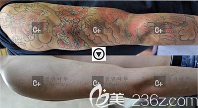韓國Clean Tattoo手臂去紋身案例 韓國Clean Tattoo手臂去紋身案例