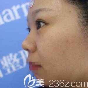 鄭州醫(yī)德佳索慧珠做假體墊下巴前 鄭州醫(yī)德佳索慧珠做假體墊下巴前