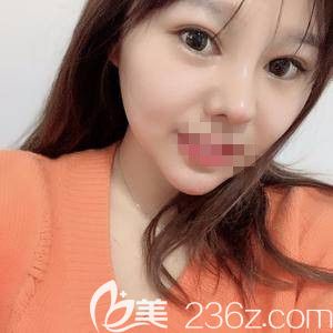 鄭州醫(yī)德佳索慧珠做假體墊下巴術后45天 鄭州醫(yī)德佳索慧珠做假體墊下巴術后45天