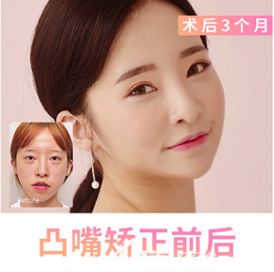 韓國eu突嘴矯正案例