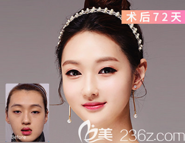 韓國EU童顏雙鄂手術(shù)改善下顎前突、地包天案例