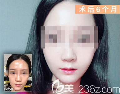 韓國EU面部不對稱矯正雙鄂修復(fù)案例