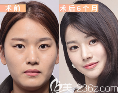 韓國EU輪廓六件套不插血袋案例前后6個月效果對比