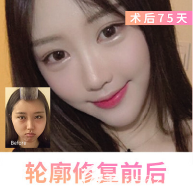 韓國EU高難度輪廓修復(fù)術(shù)案例對比圖