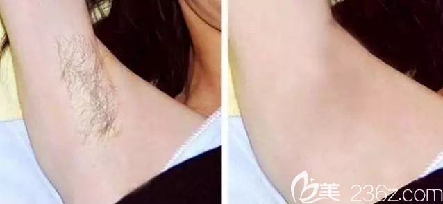 南京維多利亞分享腋下脫毛前后對比照
