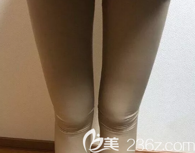 大腿吸脂術(shù)后穿塑身衣的照片