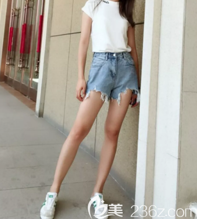 濟(jì)南做大腿吸脂手術(shù)好的醫(yī)院是濟(jì)南美蓮，我總共花了3萬塊錢做了雙側(cè)大腿吸脂