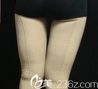 我在南寧夢想做大腿吸脂術(shù)后第7天 我在南寧夢想做大腿吸脂術(shù)后第7天