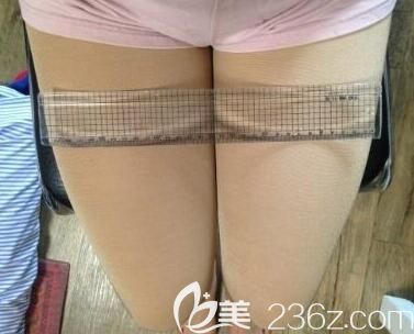 我在南寧夢想整形做大腿吸脂第30天 我在南寧夢想整形做大腿吸脂第30天