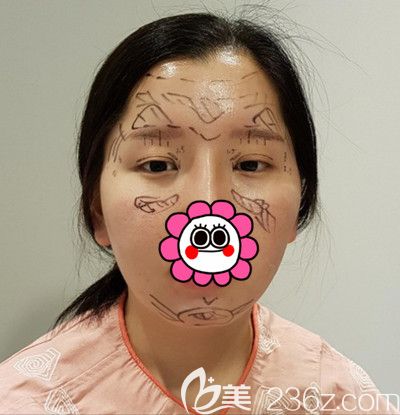 在韓國DI整形醫(yī)院做全臉脂肪填充+全切雙眼皮手術(shù)前設(shè)計(jì)