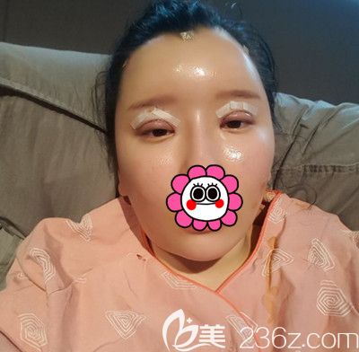 在韓國DI整形醫(yī)院做全臉脂肪填充+全切雙眼皮手術(shù)后1天
