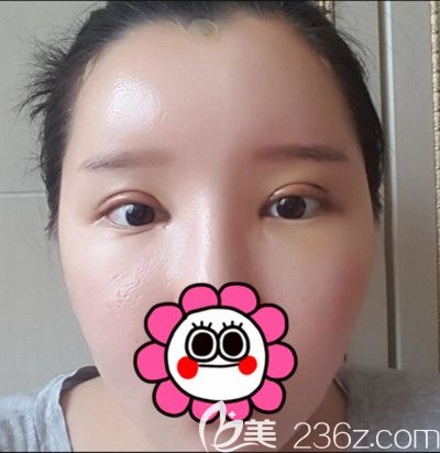 在韓國DI整形醫(yī)院做全臉脂肪填充+全切雙眼皮手術(shù)后7天