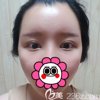 在韓國DI整形醫(yī)院做全臉脂肪填充+全切雙眼皮手術(shù)后2周