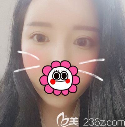在韓國DI整形醫(yī)院做全臉脂肪填充+全切雙眼皮手術(shù)后1個(gè)月