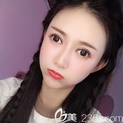 朋友們都驚呼我在深圳南雅找萬蕓做的雙眼皮和脂肪填充效果竟然這么好