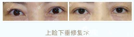 找曹仁昌做的眼睛修復(fù)案例對比圖