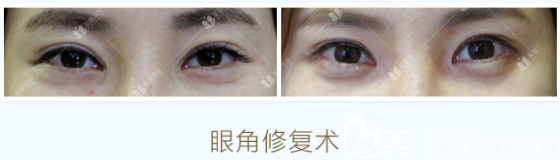 曹仁昌做的內(nèi)眼角修復(fù)案例對比圖