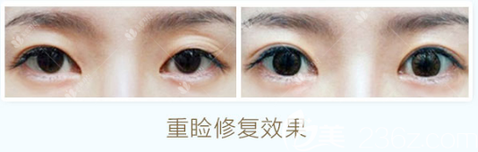 曹仁昌做的初眼重瞼修復(fù)案例