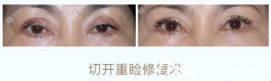 曹仁昌切開雙眼皮修復(fù)案例