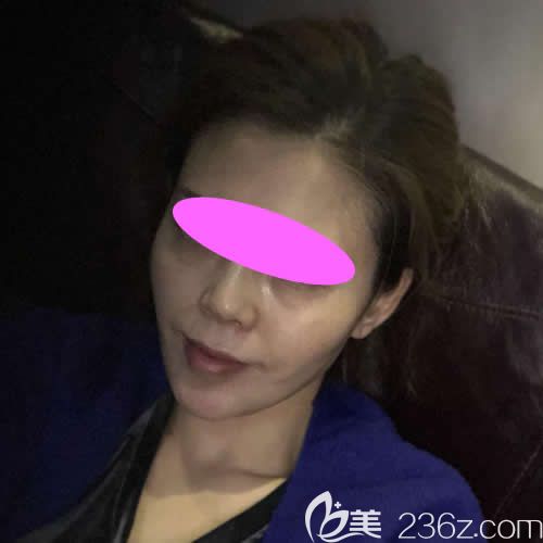 沒到西寧康華醫(yī)院做面部線雕前的照片 沒到西寧康華醫(yī)院做面部線雕前的照片