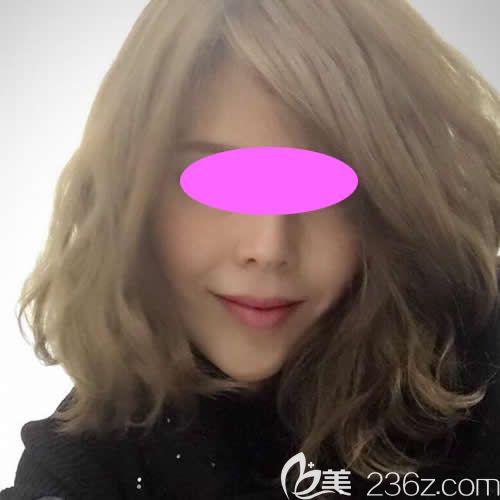 我到青海西寧康華醫(yī)院做面部線雕術(shù)后第1天照片 我到青海西寧康華醫(yī)院做面部線雕術(shù)后第1天照片