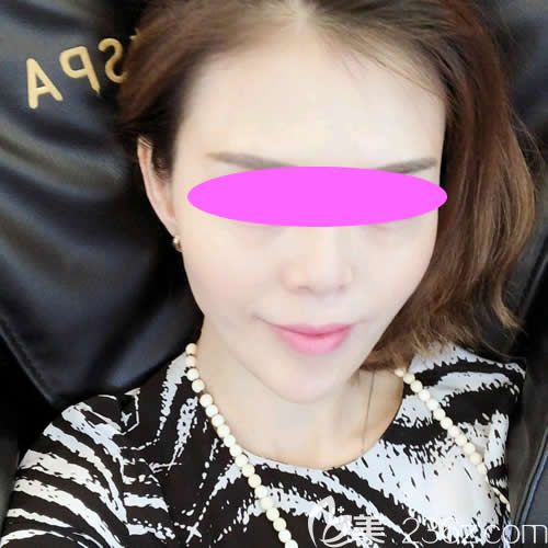 西寧哪里做線雕效果好?分享我到西寧康華醫(yī)院做面部線雕一到7天圖片給大家參考