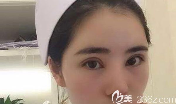 找昆明夢想做眼綜合+全切雙眼皮手術(shù)40天后竟然改善這么大