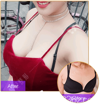 中山韓妃李光琴隆胸手術(shù)<span style=