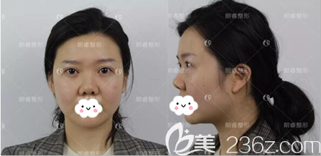 隆鼻手術(shù)前正面?zhèn)让嬲掌? alt=