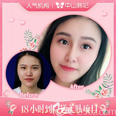 中山韓妃李光琴醫(yī)生雙眼皮手術(shù)<span style=