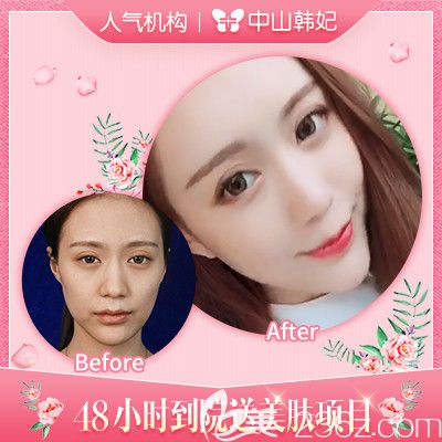 中山韓妃林社彬醫(yī)生玻尿酸全臉填充<span style=