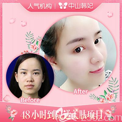 中山韓妃林社彬隆鼻和脂肪填充<span style=