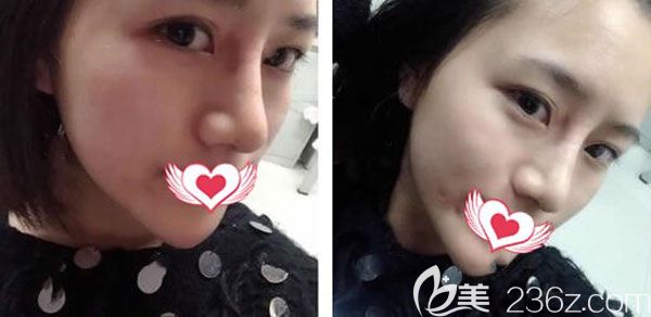 耳軟骨墊鼻尖第7天形態(tài)已經(jīng)自然了