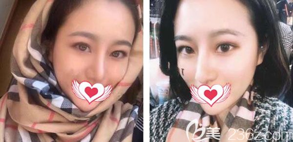 耳軟骨復(fù)合隆鼻一個月基本已經(jīng)定型