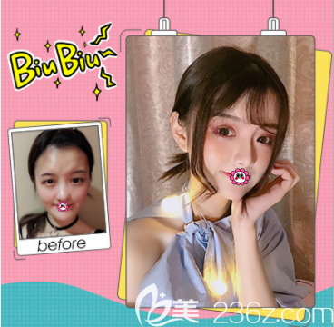 北京壹加壹張綠峰醫(yī)生埋線雙眼皮案例