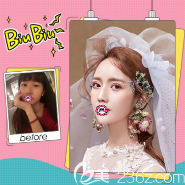 北京壹加壹丁洪如醫(yī)生切開雙眼皮案例