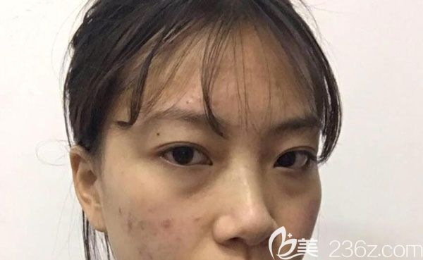 激光祛斑第7天結(jié)的痂掉的差不多了 激光祛斑第7天結(jié)的痂掉的差不多了