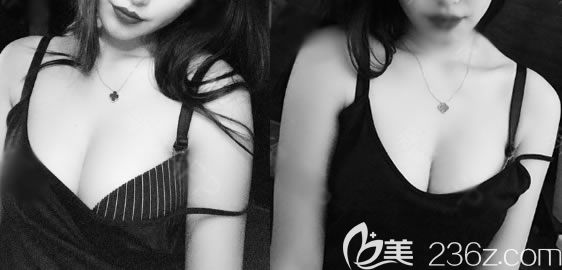 杭州薇琳自體脂肪隆胸<span style= 杭州薇琳自體脂肪隆胸<span style=