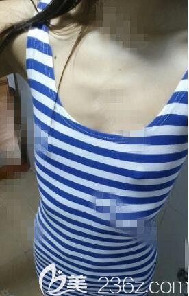 韓國瑪博爾整形外科做胸怎么樣 韓國瑪博爾整形外科做胸怎么樣