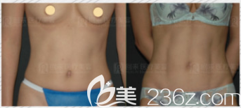 韓國純真整形醫(yī)院安敬天院長腰腹吸脂打造馬甲線案例 韓國純真整形醫(yī)院安敬天院長腰腹吸脂打造馬甲線案例