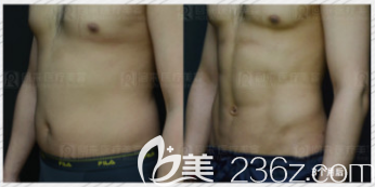 韓國安敬天院長5D吸脂雕塑打造腹肌案例 韓國安敬天院長5D吸脂雕塑打造腹肌案例