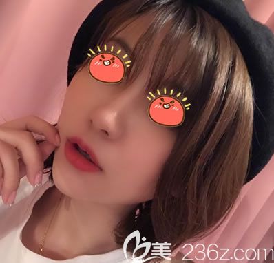 紹興上虞一美整形的名氣挺大的,看院長給我做的大腿吸脂和自體脂肪全臉填充效果怎么樣