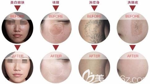 蜂巢皮秒祛斑會(huì)反彈嗎？